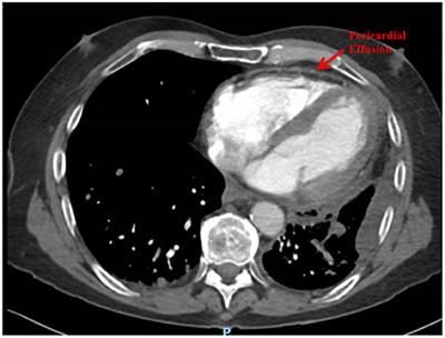 Successful immune checkpoint inhibitor rechallenge after immune-related pericarditis: Clinical case series